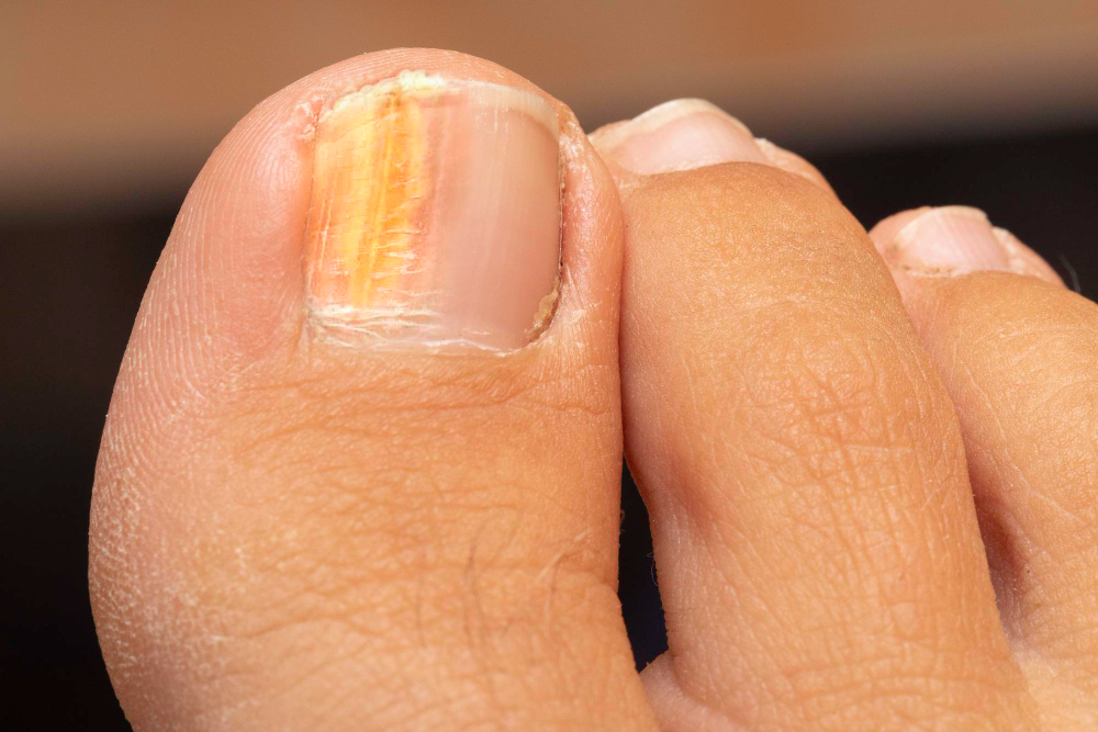 Nagelpilz frühzeitig erkennen und wirksam behandeln