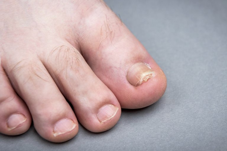 Nagelpilz im Alter: Warum Kaltplasma wissenschaftlich diskutiert wird