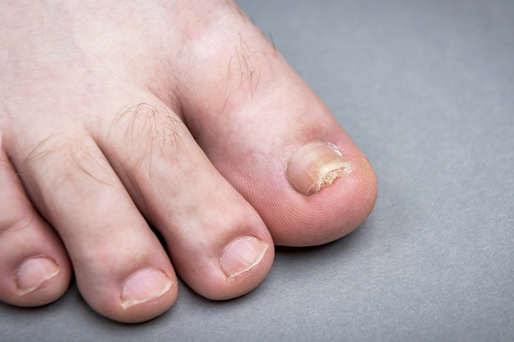 Nagelpilz im Alter: Warum Kaltplasma wissenschaftlich diskutiert wird